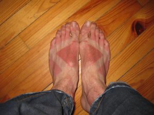 sunburn feet